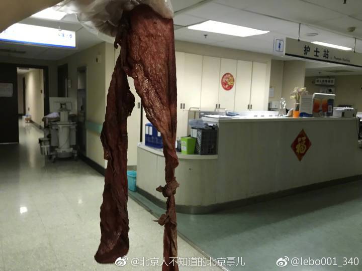 北大人民医院回应“产妇剖腹产三天后排出纱布”：系工作失误