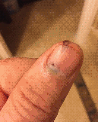指甲里的淤血是怎么出来的