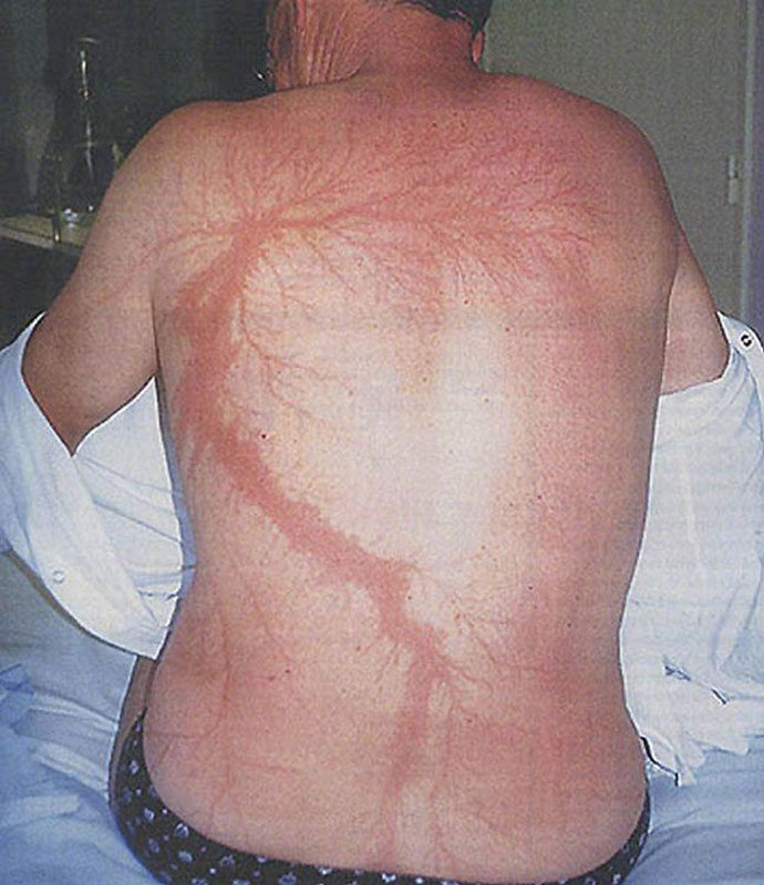 被闪电击中后幸存下来的人，身体上留下了闪电脉络般的疤痕